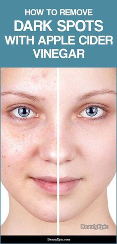 Clear Skin Naturally, Hyper Pigmentation, Onion Juice, Dark Spots On Face, Dark Spots On Skin, Forehead Wrinkles, Natural Sleep Remedies, Spots On Face