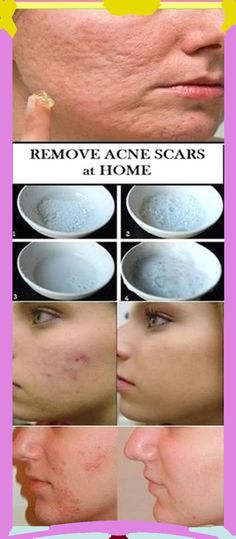 How Two Aspirins Can Help You Remove the Spots, Wrinkles and Scars of the Face! Fitness Queen, Skin Needling, Acne Mask, Brown Spots On Face, Spots On Face, Hormonal Acne, Skin Remedies