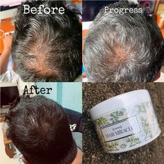 Hair Regrowth Treatments, Peppermint Oil, Virgin Coconut Oil, Hair Regrowth, Puffy Eyes, Burn Belly Fat, Tree Oil, Tea Tree Oil, Tea Tree