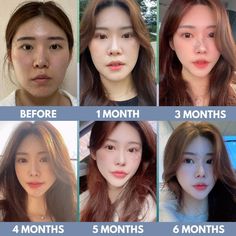 Cheekbone Reduction, V Line Surgery, Plastic Surgery Korea, Korean Plastic Surgery, Cotton Suit Designs, V Shape Face, Reduction Surgery, Facial Contouring, Dump Ideas