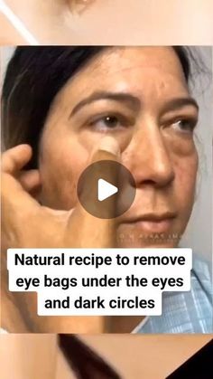 Nature'sRemedyLab on Instagram: "NATURAL RECIPE TO REMOVE EYE BAGS UNDER remove

THE EYES AND DARK CIRCLES

Leve bags under the eyes

#darkcircles

#skin#naturalremedy circles

#womenshealth

#healthy#uganda#southafrica

#worldwide #naturalremedies" Undereye Bags Remedy, Eye Bag Remedies, Eye Health Remedies, Eye Bags Makeup, Puffy Eyes Remedy, Remove Eye Bags, Brown Spots Removal, Eye Exercises