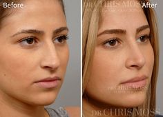 Natural Nose, Plastic Surgery Facts, Face Fillers