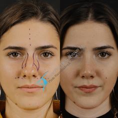 Best Rhinoplasty Before After, Wide Nose Rhinoplasty