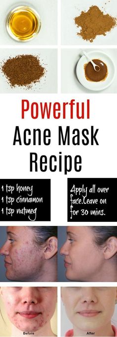 Overnight Face Mask For Acne, Best Home Remedy For Acne, Home Remedy For Acne, Natural Acne Mask, Diy Overnight Face Mask, Homemade Acne Mask, Remedies For Pimples, Remedy For Acne, Face Mask For Acne