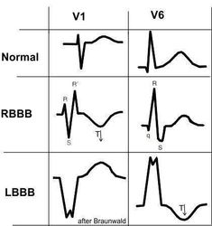 Lbbb Vs Rbbb, Paramedic Student, Cardiac Sonography, Cardiology Nursing, Nurse Practitioner School