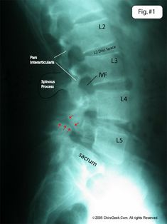 Good info: Spondylolisthesis - collapse/stenosis of the neuroforamen (the place where your delicate nerves leave the spine) and central canal, which can compress exiting nerve roots resulting in severe back and leg pain (sciatica) Pars Defect, Nursing Life, Hip Problems, Musculoskeletal Pain, Psoas Muscle