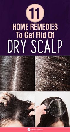 Get Rid Of Dry Scalp, Remedies For Dry Scalp, Itchy Flaky Scalp, Dry Flaky Scalp, Scalp Moisturizer