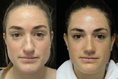 Nose Tip Surgery Before After, Wide Nose Rhinoplasty, Kpop Plastic Surgery, Crooked Nose, Jaw Reduction Surgery, Bulbous Nose, Korean Plastic Surgery