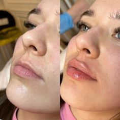 Ekkora eredménnyel jár, 1ml hialuron! 🫢💋  #teosyal #drgoodwin #doctor #beforeandafter #lips #lipfillersbeforeandafter #lipfiller #beautysalon #lips Narrow Mouth Lip Filler, Lip Filler Transformation, Lip Flip With Filler, Best Lip Filler, Lip Filler Downturned Lips, Lip Injections Inspiration, Lip Filler Examples, 5 Ml Lip Filler, Perfect Lip Filler