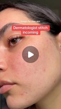 Dr. Neera Nathan on Instagram: "There is ONE product that can treat acne, post-acne marks, redness, rosacea, perioral dermatitis, melasma and hyperpigmentation - and it’s not a retinoid.

Azelaic acid is probably the most underrated, highly versatile skincare active thanks to its anti-inflammatory and pigment-reducing properties. It naturally occurs in grains and is available in a number of over the counter skin care products at a 10% concentration (it comes in higher strengths as a prescription).

To use, apply a thin layer twice daily. Follow with sunscreen in the AM and moisturizer at night. If you have sensitive skin, limit use to once daily. 

@rubysacne 

#azelaicacid #acne #skincaretips #fyp" Post Acne Marks, Treat Acne, Azelaic Acid, Acne Marks, Hair Wear, How To Treat Acne, Clear Skin, Skin Care Tips