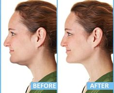 ➤ Wonder how to get rid of your double chin? ➤ Try the NEW SlimChin® Face Toning Jaw Exercise Ball!➤ All it takes is 10-15 minutes a day to see the difference! ➤ Reduce double chin and firm sagging skin➤ Help to lose face fat without surgery➤ Promotes strong and healthy jaw muscles➤ Creates more toned shape for your face, neck, and jawline ➤ Perfect aesthetics, skinnier, younger-looking appearance➤ Join the movement and get the jawline of your dreams. Face Fat Loss, Muscles Of The Neck, Neck Tightening, Neck Muscles, Slim People, Neckline Slimmer