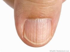 Longitudinal ridging is found on the nails in the shape of vertical marks or lines running from the base of the fingernail to the top. Fingernail Ridges, Nail Health Signs, Nail Symptoms, Fingernail Health, Nail Ridges, Hair Nutrition, Health Signs