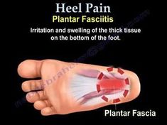 Facitis Plantar, Foot Pain Relief Remedies, Heel Pain Relief, Pain Relief Remedies, Foot Exercises, Back Pain Remedies, Foot Pain Relief, Neck And Back Pain, Heel Pain