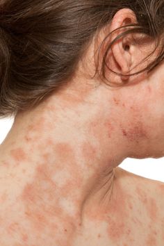 Atopic Skin, Itchy Rash, Home Remedies For Skin, Body Organs, Natural Home Remedies, Natural Home, Health And Fitness Tips, Health Advice, Neck Pain