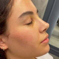 Button Nose Vs Straight Nose, Natural Looking Nose Job, Nose Job Inspiration Natural, Plastic Surgery Before And After, Bulbous Nose Rhinoplasty Before After, Natural Nose Job, Feminine Nose