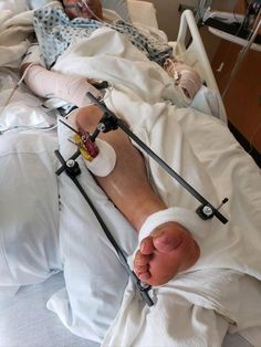 an injured person laying in a hospital bed with medical equipment around his ankles and feet