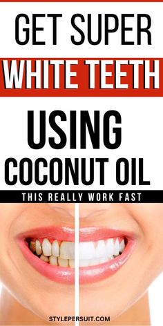 TIred stained teeth or yellow teeth. Are you looking natural way to whien your teeth? Coconut oil is an effective natural ingredient for teeth whitening. Learn how to whiten teeth with coconut oil for a great oral hygiene and health teeth. Strengthen Teeth, Teeth Whitening Diy, Whiten Teeth, Yellow Teeth, Stronger Teeth, Gum Care, Stained Teeth, Gum Health