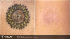 before and after photos of laser tattoo removal