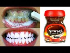 In this video, you'll learn a quick and easy natural method for whitening your teeth in just one minute using coffee. We'll go over the simple steps you need... At Home Teeth Whitening, Natural Teeth Whitening Diy, Natural Teeth Whitening Remedies, Baking Soda Teeth, Home Teeth Whitening, Alcohol Free Mouthwash, Tartar Removal, Dental Decay