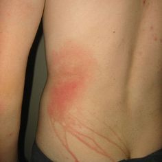 the back of a man with red marks on his stomach