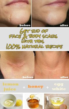 Get rid of face and body scars with this 100% natural recipe: Obličejové Masky, Beauty Remedies, Acne Remedies, Skin Remedies, Diy Skin, Health And Beauty Tips, Beauty Treatments, Face Care, Natural Food