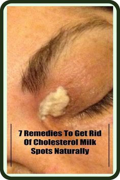 7 Remedies To Get Rid Of - Cholesterol Milk Spots Naturally by Kristijan Velichkovski | This newsletter was created with Smore, an online tool for creating beautiful newsletters for educators, nonprofits, businesses and more Cosmetic Procedures, Skin Diseases, Skin Care Treatments, Health Awareness, Skin Problems, Keratin