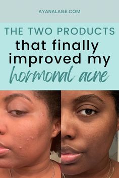 Dealing with hormonal acne? Here are two products that changed my skincare journey for the better — and one is over-the-counter. Acne In Your 40s Skincare, Tretinoin Before And After Acne, Hormonal Acne Skincare Routine, Skincare Products For Acne, In Your Thirties, Hormonal Acne Remedies, Products For Acne, Acne Skincare, Best Face Wash