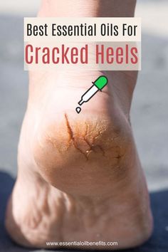 Healing Cracked Heels, Seasickness Remedies, Essential Oils For Nails, Cracked Heel Remedy, Essential Oils Logo, Cracked Heel Remedies, Cracked Heel, Tandoori Masala