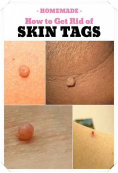 Destroy Your Moles, Warts, - Blackheads, Skin Tags and Age Spots Completely Naturally by tHERESA mURRAY | This newsletter was created with Smore, an online tool for creating beautiful newsletters for educators, businesses and more Beauty Remedies, Diy Beauty Hacks, Health Remedies, Natural Healing, Blackheads, Skin Health