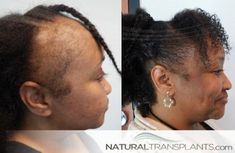 Hair Transplant Before and After Images - Female Hair Growth Methods, Best Hair Transplant, Hair Clinic, Hair Thinning, Afro Hair