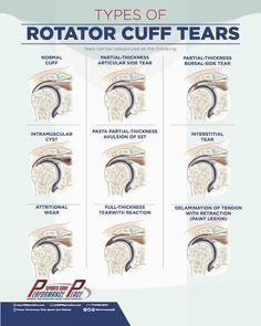 Shoulder Surgery Recovery, Rotator Cuff Pain, Shoulder Rehab Exercises, Rotator Cuff Exercises, Rotator Cuff Surgery, K Tape, Shoulder Rehab, Rotator Cuff Tear