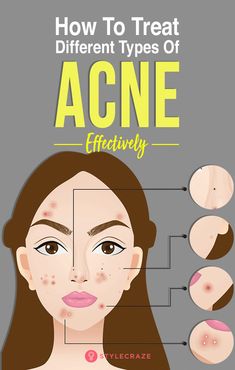 Acne is the most annoying skin condition that affects almost all the teenagers. There are different types of acne. Know how these various types of acne can be identified Forehead Acne, Lotion For Oily Skin, Skincare Acne