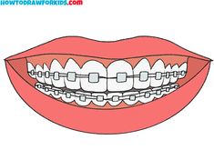 an open mouth with braces on it and teeth in the middle, which are connected to