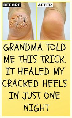 Cracked Heel Remedies, Cracked Heels, Brittle Nails, Tooth Decay, About Hair, Insomnia, Home Remedies, Natural Remedies, Healthy Skin