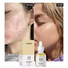 New 60% Propolis Acne Glow Serum + Salicylic Acid + Niacinamide Repair & Moisturize 1oz/30ml Brand New With Box Natural Propolis, Which Has Long Been A Key Ingredient In The Treatment Of Acne, Breakouts And The Reduction Of Excess Sebum, Has Antibacterial And Anti-Inflammatory Properties. This Is A Highly Effective Serum That Intensively Nourishes The Skin, Leaving It Healthy And Glowing And Preventing Premature Aging. Key Ingredient: 60% Propolis: First Aid Scabies, Reduce Breakouts. Salicylic Skin Moles, Firming Eye Cream, Glow Serum, Acne Serum, Cream For Dry Skin, Dewy Skin, Facial Mist, Anti Acne, Hand Lotion