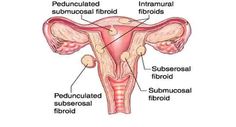 Uterine fibroids: Here are some facts you must know TheHealthSite.com Testosterone Booster Food, Testosterone Boosting Foods, Increase Bone Density, Men Health, Frequent Urination, Increase Testosterone, Testosterone Booster, Reduce Body Fat, Leg Pain