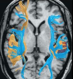 Mind Video, Brain Scans, Fantastic Video, Dyslexic Students, Brain Game, Literacy Coaching, Dysgraphia, Brain Facts, Brain Scan