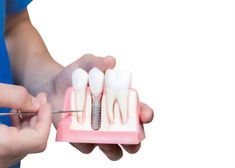 Every time you replace a tooth with a #dental implant, there are three parts involved: the implant, the implant abutment, and the fixed #restoration. Teeth Replacement, Implant Dentist, Denture Implants, Dental Implant Surgery, Dental Technician, Oral Surgeon, Tooth Replacement