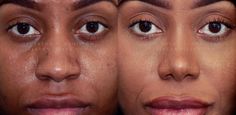 Rhinoplasty Inspiration, Rhinoplasty Before And After, Perfect Nose, Nose Surgery, Nose Job, Cosmetic Procedures