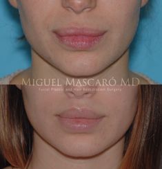 Surgery Inspiration, Upper Lip Hair, Best Plastic Surgeons, Face Lift Surgery