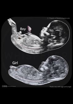 Baby Boy Ultrasound Pictures, Baby Ultrasound Pictures Ideas, Ultrasound Boy Or Girl, Boy Ultrasound Pictures, Boy Or Girl Prediction, Boy Ultrasound, Baby Ultrasound Pictures, Nub Theory, Vom Avea Un Copil