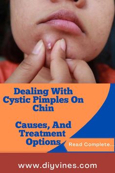 Cystic pimples on chin are the worst. Especially if you're someone who struggles with acne. Cystic pimples on chin are painful and difficult to get rid of. Pimple Solution, Pimple Causes, Cystic Pimple, Pimple Marks