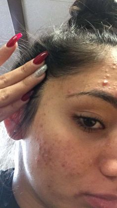 Teen shares how she cleared her severe acne using cheap products Index Teen Acne Skincare Routine, Yeast Acne, How To Clear Up Acne, Acne Transformation, Acne Photos, Girl With Acne, Cheek Acne, Acne Positivity, Skin Positivity