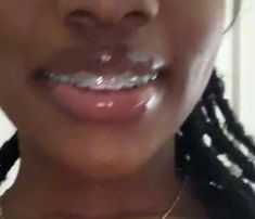 Braces And Lipgloss, Braces Aesthetic Girl Black, Braces Dark Skin, Braces On Black Girls, Braces Colors Ideas Dark Skin, Pretty Teeth