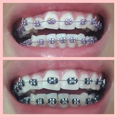 Braces First Day, Powerchain Braces Colors Ideas, Black Braces Teeth, Braces Color Power Chain, Brackets Aesthetic, Pink Power Chain Braces, Powerchain Braces Colors Pink, Cute Power Chain Braces, Damon Braces