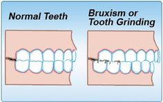 Teeth grinding (bruxism) usually occurs at night while the sufferer sleeps, and normally it is first noticed by the person’s spouse. In children, teeth grinding is likely to go unnoticed until significant damage has occurred. Bruxism should be considered….
#remediesforgumpain Teeth Grinding, Dental Facts, Deep Breathing Exercises, Grinding Teeth, Acupressure Points, Cognitive Behavioral Therapy, Behavioral Therapy