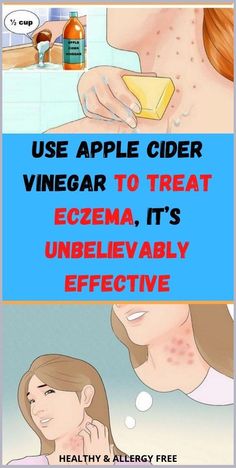 Use Apple Cider Vinegar To Treat Eczema, It�s Unbelievably Effective Artery Cleanse, Apple Cider Vinegar Uses, Inflamed Skin, Healthy Life Hacks, Intimate Wash, Vinegar Uses, Healthy Advice, Health Planner, Healthy Skin Tips