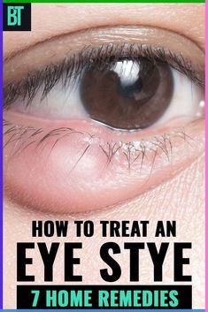 7 home remedies for an eye stye. How to treat an eye stye at home to get rid of it quickly. Read also about the causes and types of an eye stye that appears on adults and kids. Sty In Eye Remedies, Stye Causes, Get Rid Of Stye, Stye Remedy, Eye Stye Remedies, Soothing Face Mask, Facial Massage Techniques, Facial Tips, Types Of Eyes