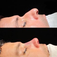 Nose Job Inspiration Men, Ideal Nose, Xbox Room, Nose Plastic Surgery, Nose Surgery Rhinoplasty, Rhinoplasty Nose Jobs