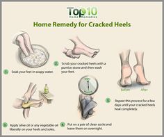 Remedy For Cracked Heels, Fix Cracked Heels, Remedies For Cracked Heels, Heal Cracked Heels, Cracked Heel Remedies, Dry Heels, Dry Cracked Heels, Top 10 Home Remedies, Cracked Heel